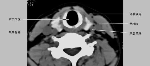 喉部病变做核磁还是ct,耳鼻喉科常见病影像诊断