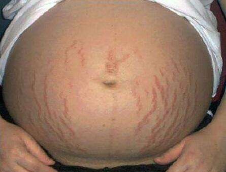 妊娠纹在家怎么淡化,妊娠纹怎么能不长