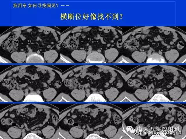 阑尾炎课件,阑尾炎的超声课件