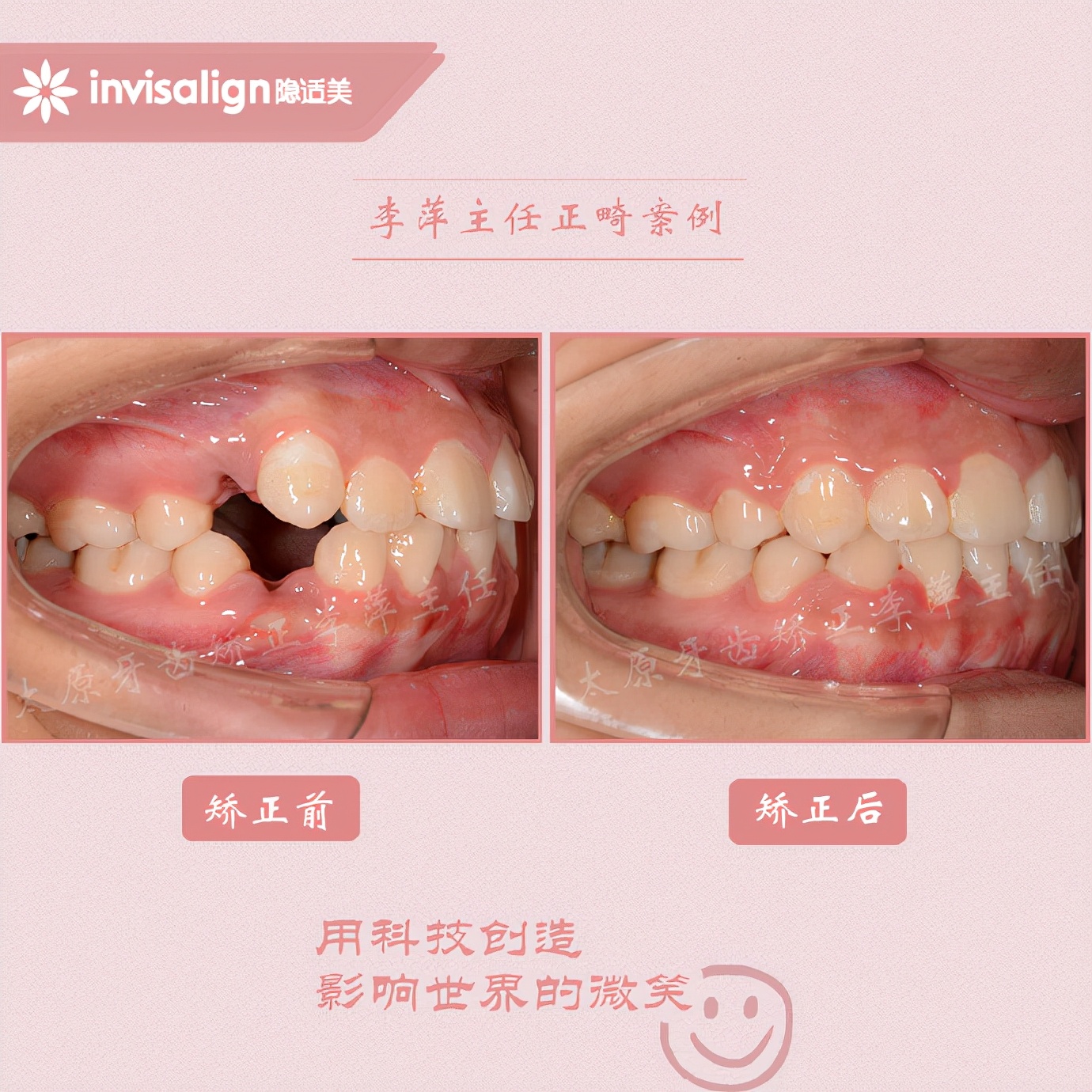 深覆合牙齿矫正不拔牙打骨钉,太原矫正牙齿需要做正颌吗