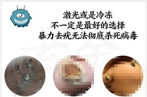 6岁儿童丝状疣怎么治疗,小孩子得寻常疣是什么原因造成的