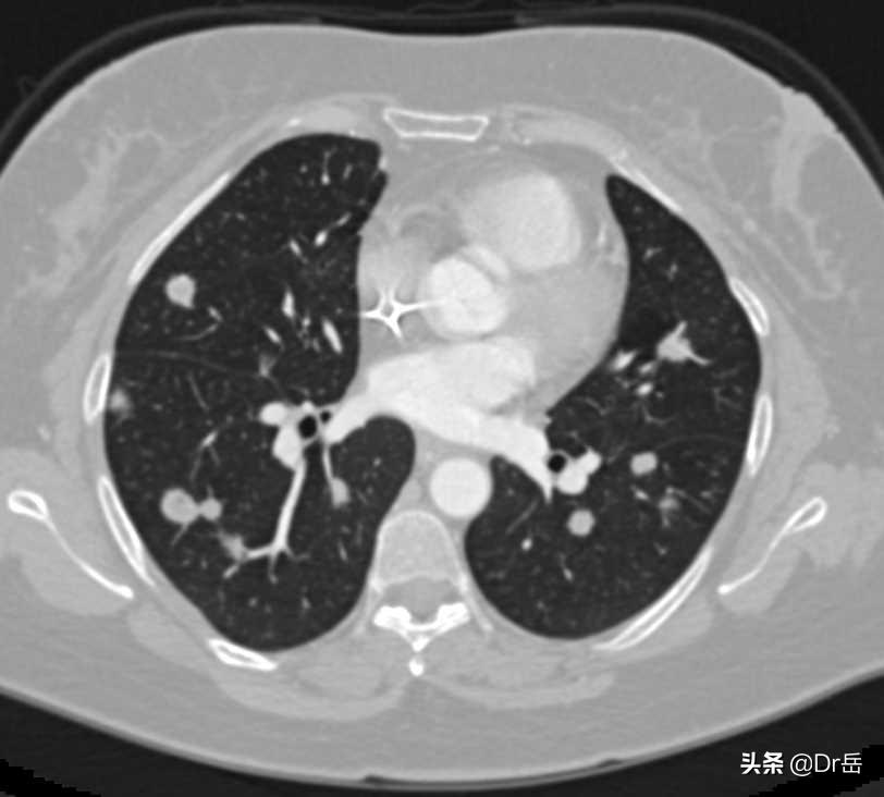 肾癌晚期肺转移痔疮敢动手术吗,肾癌做保肾手术好还是切除手术好