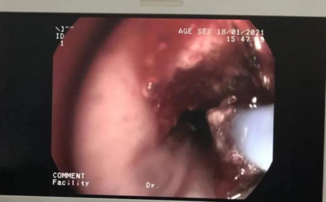 硬质支气管镜是什么手术,超导可视支气管镜介入治疗