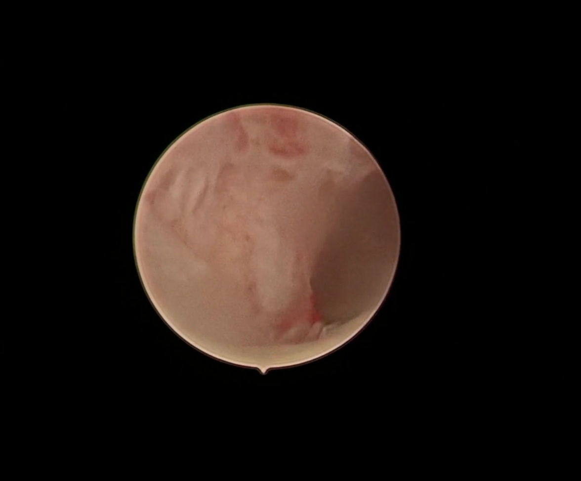 轻微宫腔粘连手术成功案例,轻度宫腔粘连分离术是大手术吗