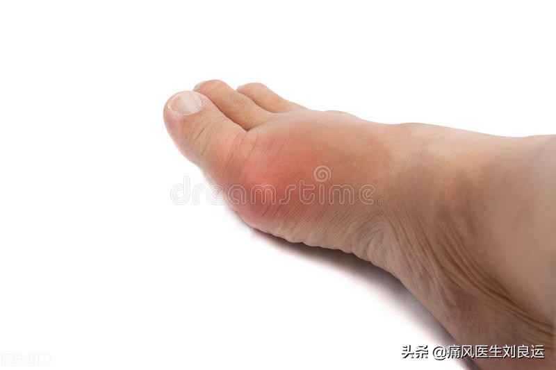 痛风会在脚趾和膝关节同时发作吗,痛风发作从脚趾头到脚踝又到膝盖