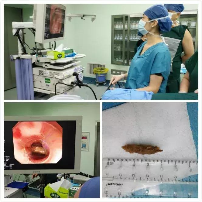 准妈妈遭遇紧急情况消化内镜医生显神通——市中心医院消化内科在内镜下成功为准妈妈取出误食枣核