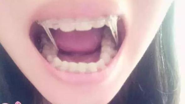 戴全瓷牙套全过程视频,戴牙套的亲身经历全过程