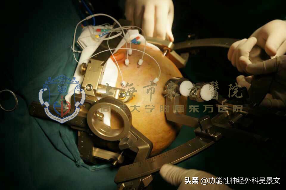 癫痫热凝术复发率高吗,难治癫痫可以用新药控制住吗