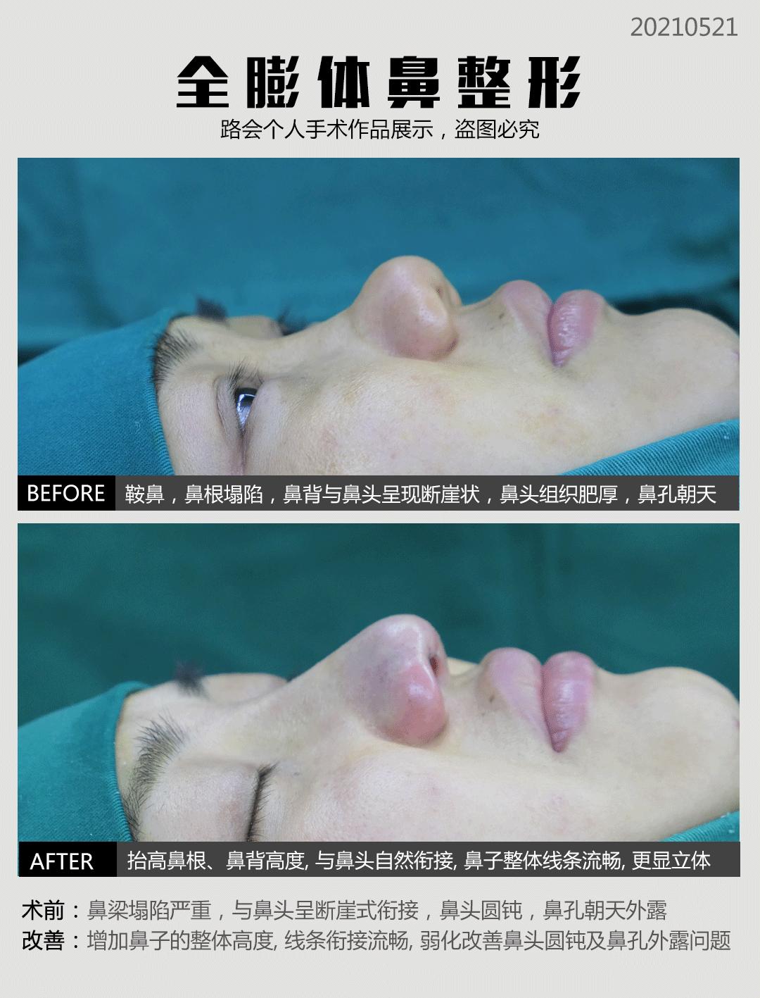 线雕隆鼻和软骨隆鼻哪个好,线雕隆鼻跟假体隆鼻哪个好看