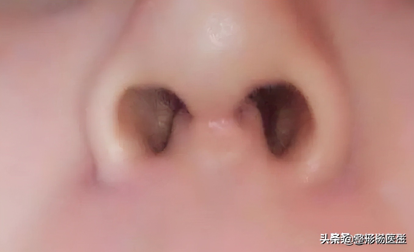 六种常见的失败隆鼻手术,隆鼻怎么预防鼻头越来越尖
