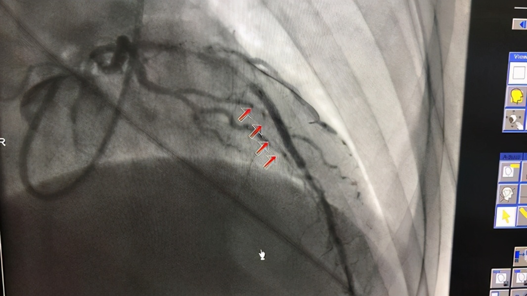 阵发性心动过速可出现呼吸困难,心绞痛,心率过快患者需改善体质