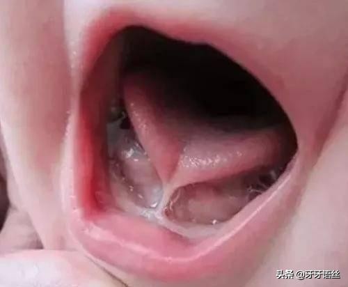 舌系带短会导致孩子不说话么,舌系带过短会影响孩子发音不准吗