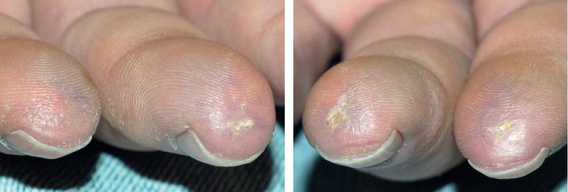 多发性硬化症和系统性硬皮病,系统性硬皮病有什么症状