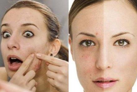 40岁下巴长痘怎么彻底治好,下巴唇下长痘痘的正确消除方法