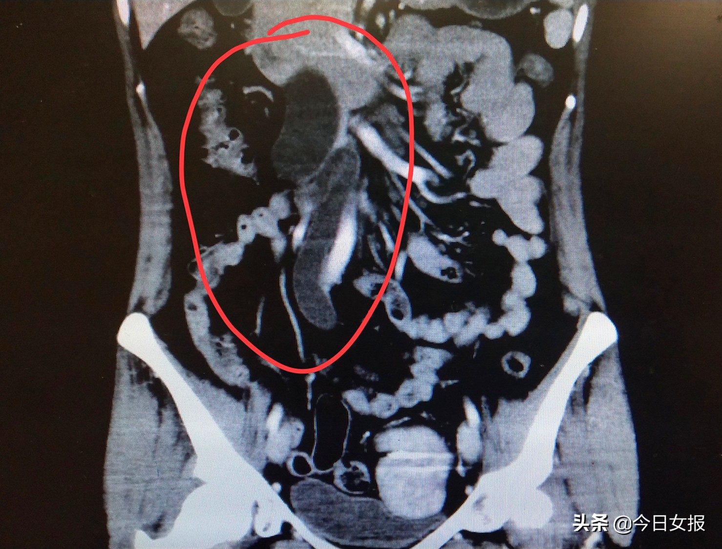 长沙40岁女子腰疼半年重度肾积水，月经反复来访！罪魁祸首竟是这发病率高达10%的妇科病