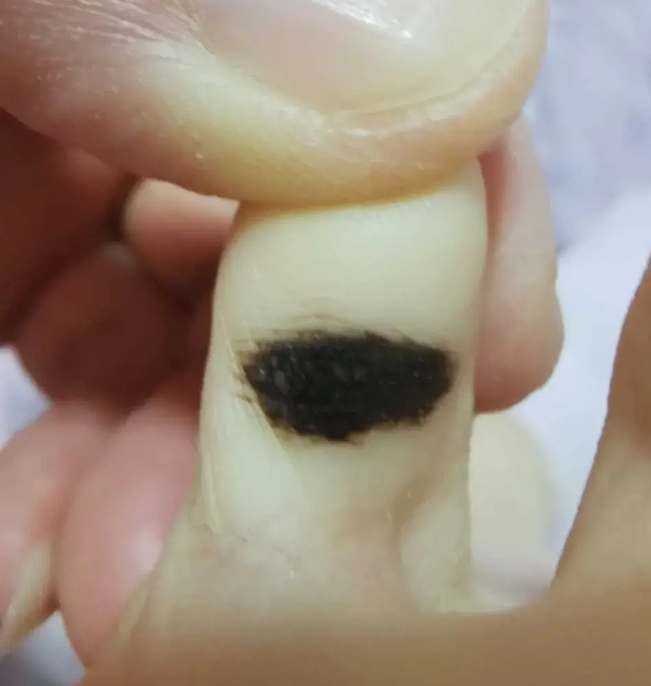 黑色素瘤诊疗规范,黑色素瘤诊疗规范2022