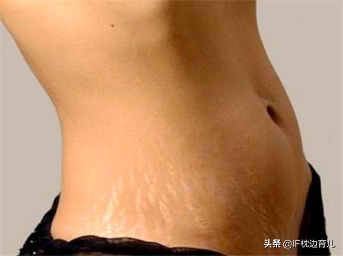 怀孕后如何预防妊娠纹,怀孕以后怎么预防妊娠斑