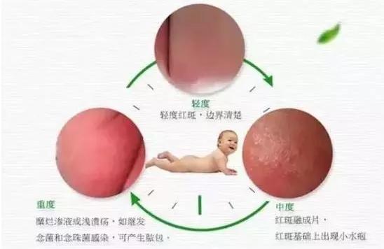 宝宝为什么一直红屁屁长疹子,为什么宝宝都会红屁股