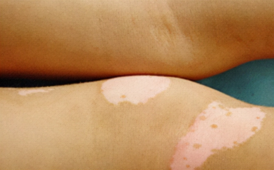 白癜风的常见治疗误区都有哪些,得了白癜风一定要注意这2点