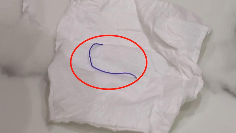 做了线雕线头出来了是正常现象吗,做完线雕半年针孔处出现异物