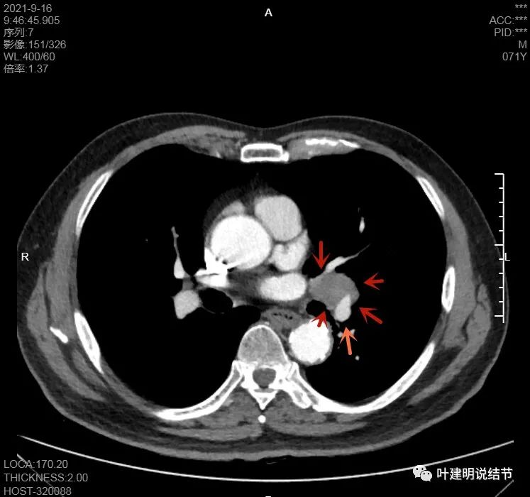 肺上有实性结节6mmx5mm是什么原因,肺上有1.7x1.8的实性结节该怎么办