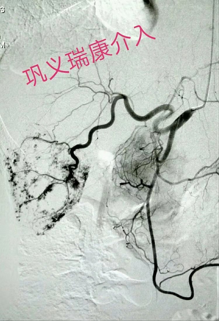 肝血管瘤做微创好还是手术好,巨大肝血管瘤介入手术缺点