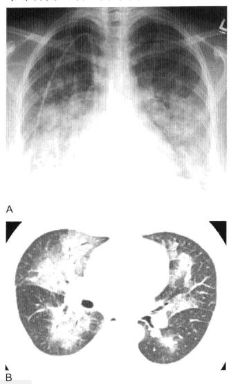 肺实变和肺炎的影像学区别,肺实变图