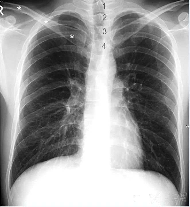 正常胸片图片,正常的胸片讲解