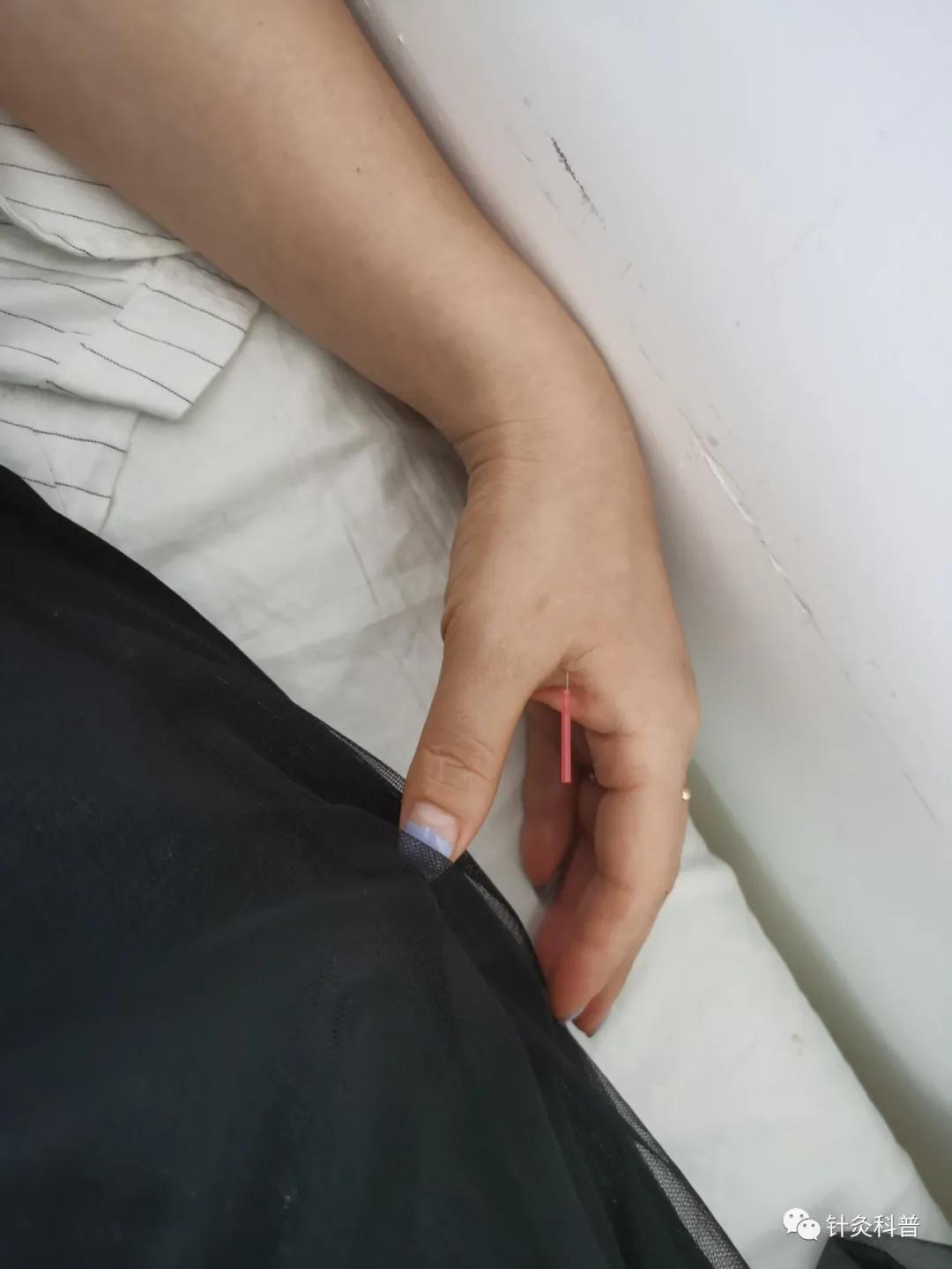 针灸后偏头痛是怎么回事,针灸治疗偏头痛是什么原理