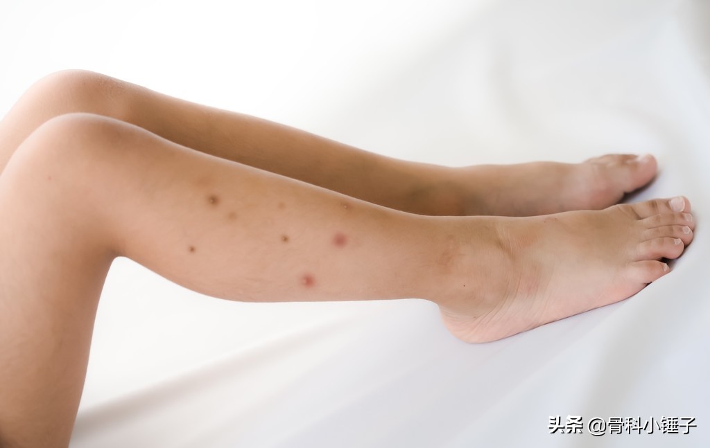 异位性湿疹是什么症状,什么是皮损性湿疹