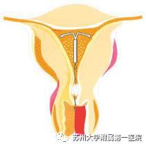 为什么只是痛经，医生却让我上环？