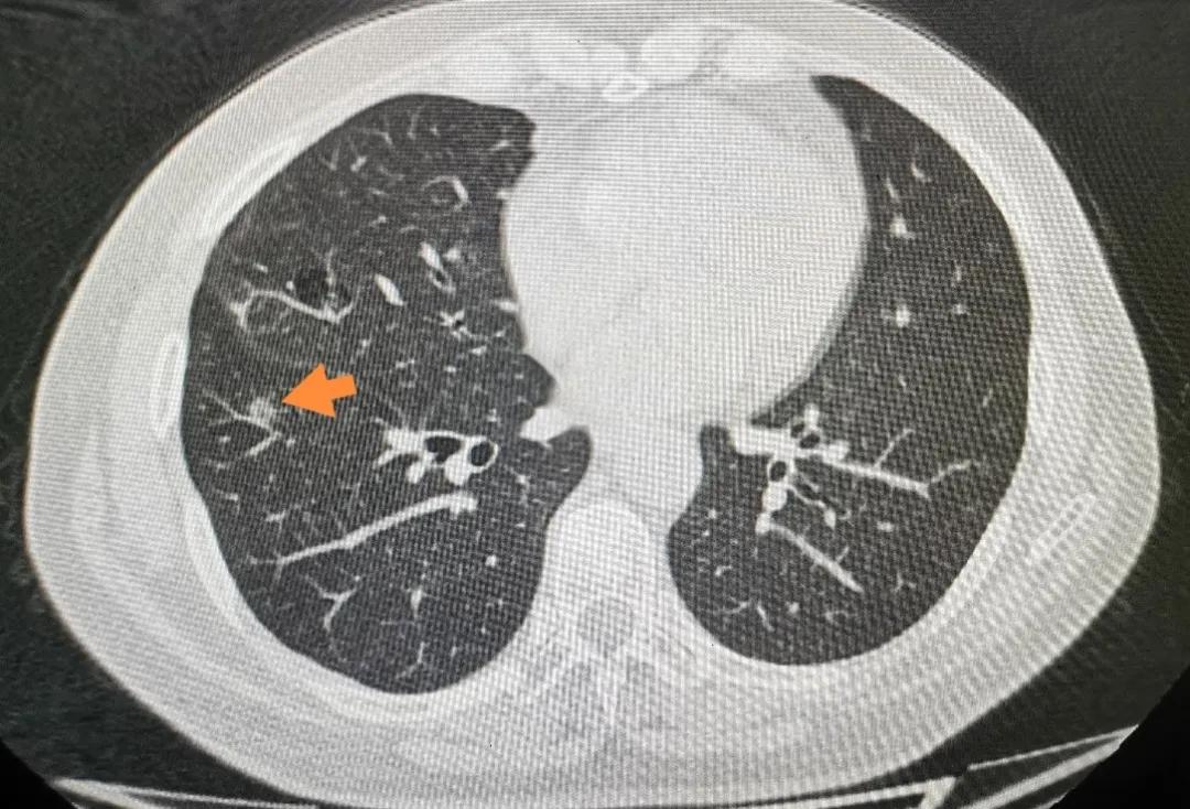 肺结节多学科联合诊疗,多学科会诊肺结节