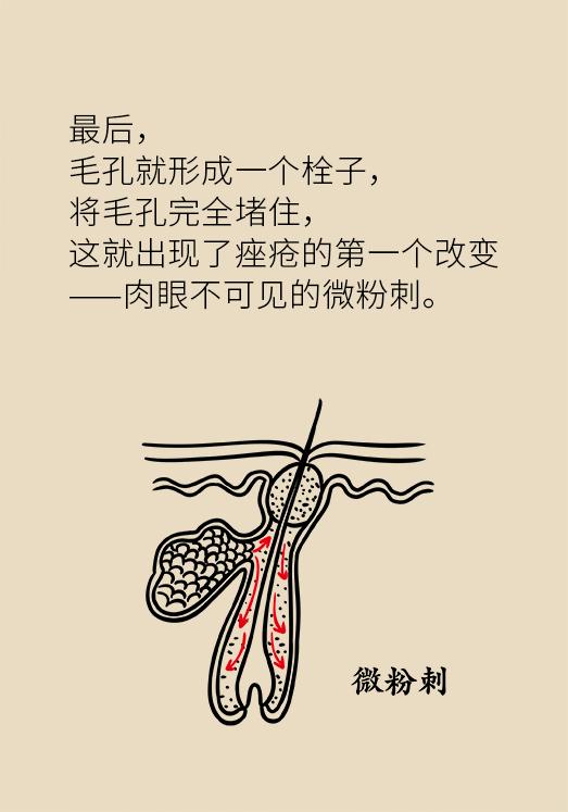 协和医院教你祛痘,长痘别着急中医祛痘秘方来帮你