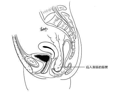 腹股沟疝有几种类型如何鉴别,腹股沟疝有哪些特点