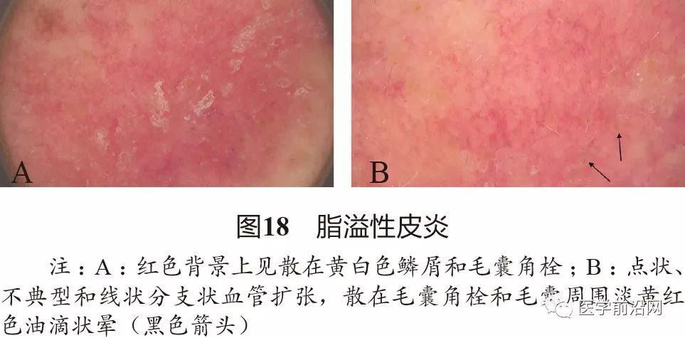 面部常见皮肤病皮肤镜诊断专家共识全文发布