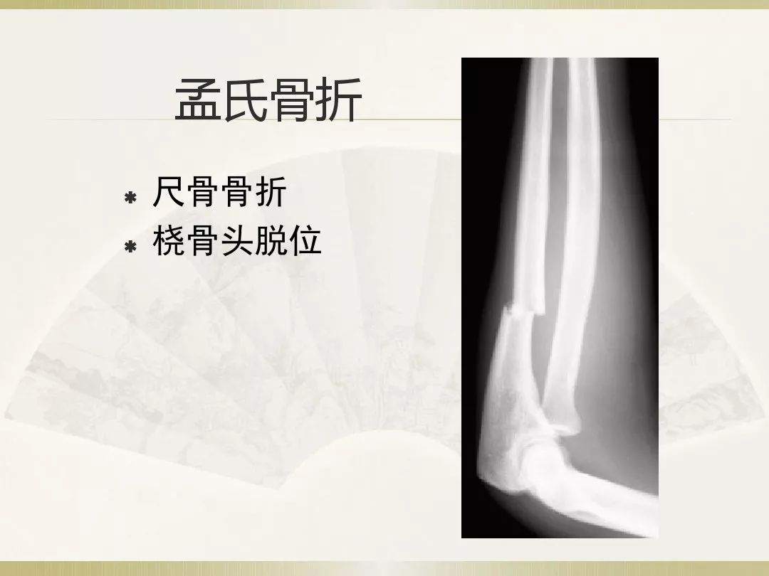 骨科x光片读片技巧,放射科骨科读片教程