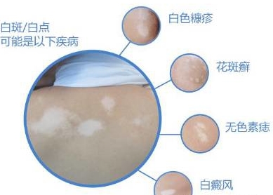 夏天到了身上流汗痒怎么解决,夏天到了总是大汗淋漓怎么缓解