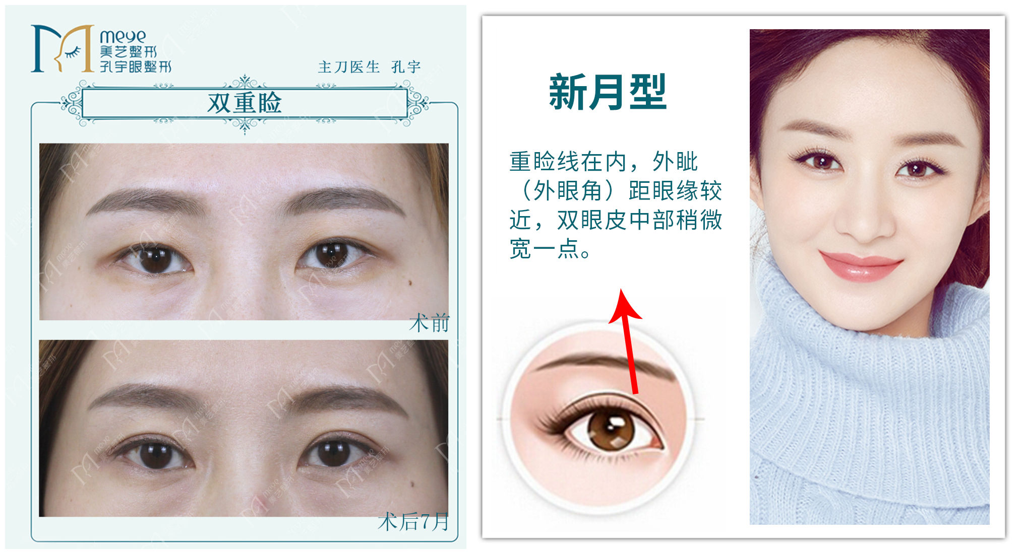 为什么有人割了双眼皮反而不好看,为啥有些人割了双眼皮变化巨大