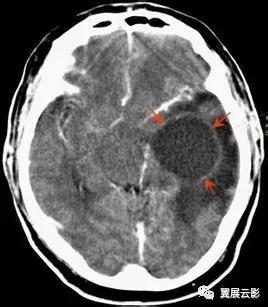 脑脓肿增强扫描是环形强化吗,脑部脓肿