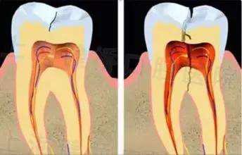 牙齿的隐形矫正,牙隐裂发生最多的牙齿