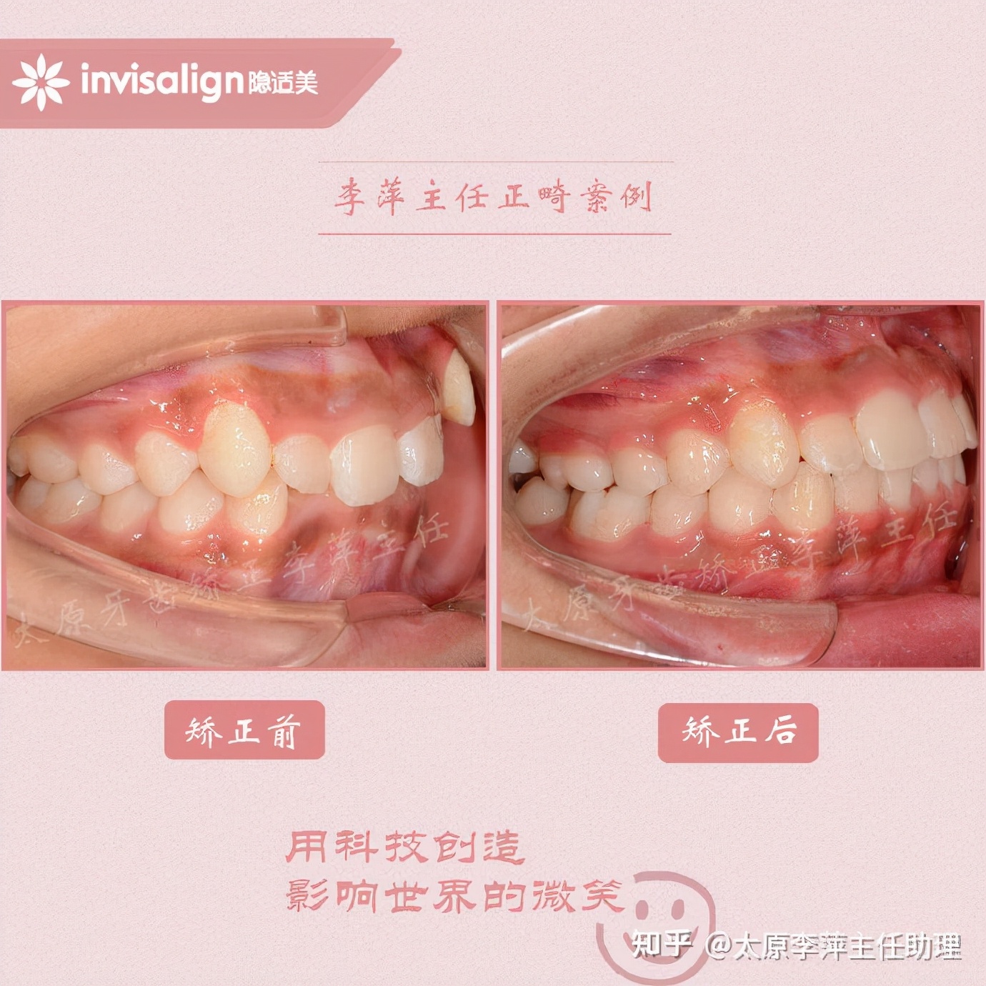 太原牙齿矫正靠谱吗,太原成人隐形牙套牙齿不齐