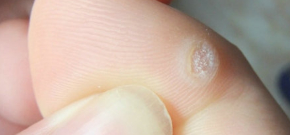 鸡眼会感染脚气吗,鸡眼会不会引起真菌感染