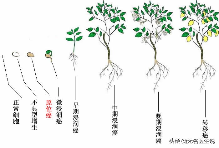 癌症的癌细胞,肺部原位癌是癌症吗