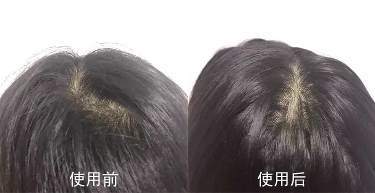 清爽头皮不掉发洗发露,秃头油腻头屑多洗发水推荐