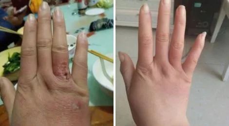 冬天脚跟干裂又起皮怎么办,冬天脚跟干裂起硬皮擦什么保湿好