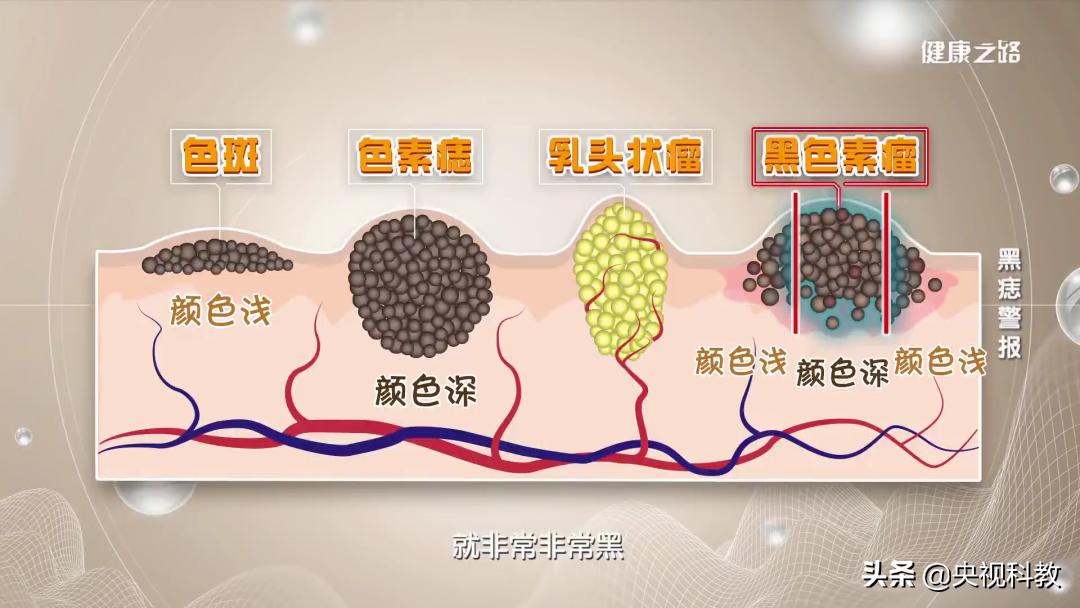 身上的黑痣有癌变的风险吗,身上长黑痣怎样防止恶变