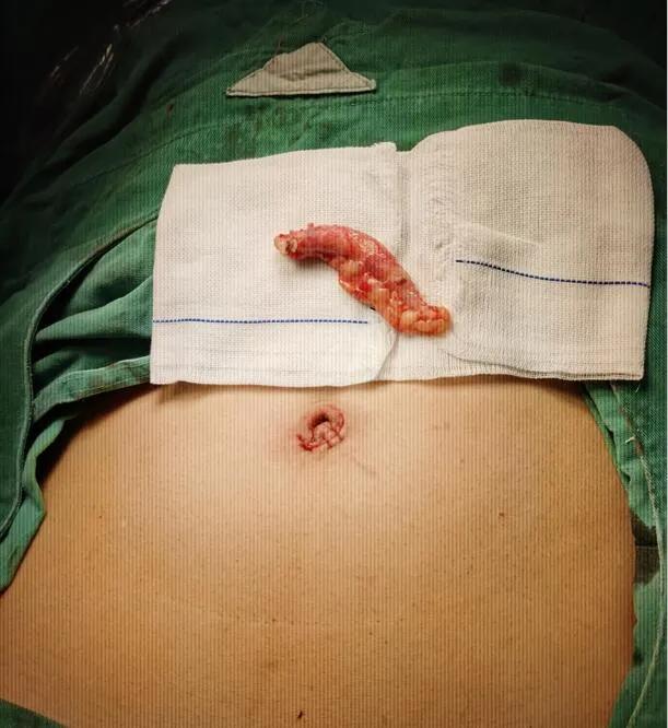 山东医专第一附属医院成功开展首例单孔腹腔镜阑尾切除术