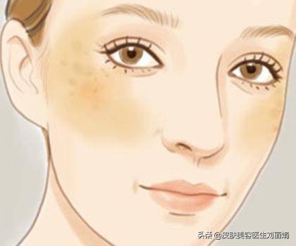 不复发黄褐斑怎么治疗,褐斑病是什么病症