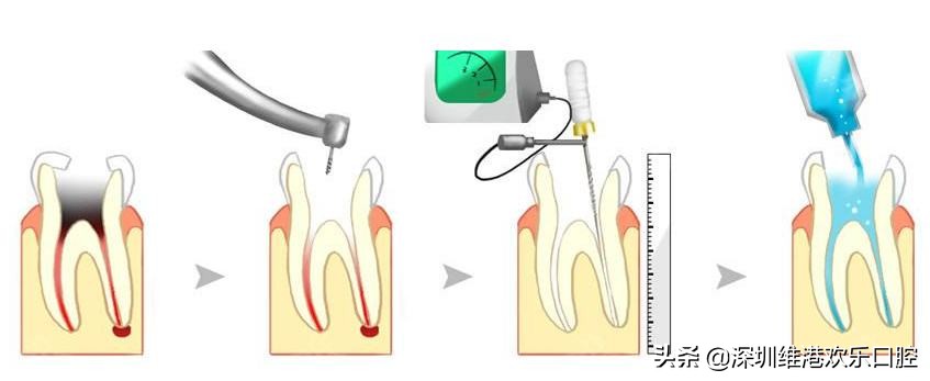 根管治疗不彻底多久会复发,根管治疗一年了还是会痛