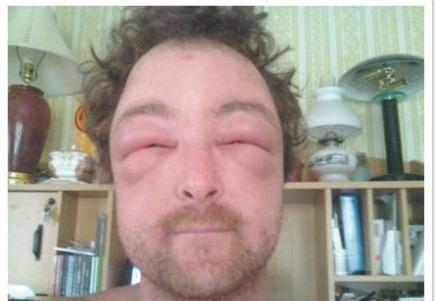 蜂蜇伤急救处理的方法,蜂蜇伤急救处理方法